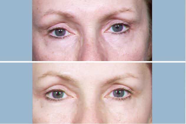 kcny blepharoplasty