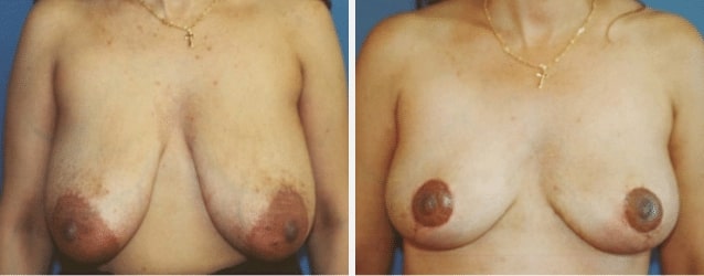breast reduction case featured