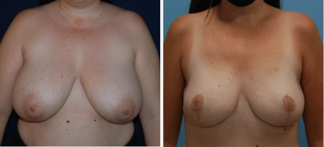 flap breast reconstruction case featured