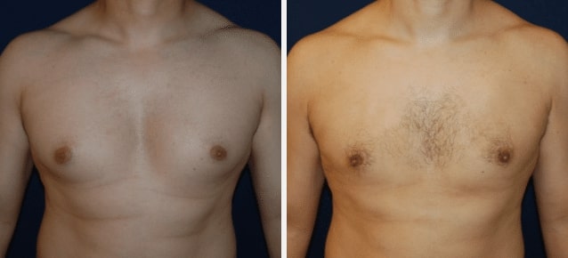 gynecomastia case featured