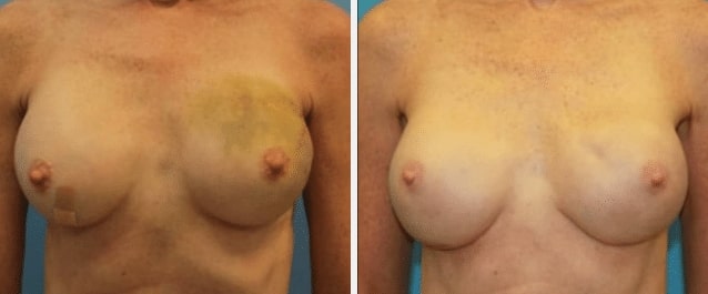 implant breast reconstruction case featured