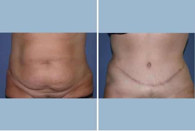 Mini Tummy Tuck NYC  Tone Your Midsection Elegantly