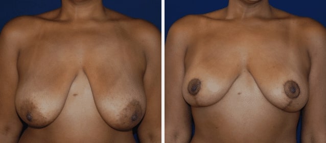 mastopexy featured case