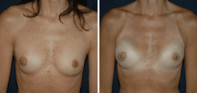 nipple sparing breast reconstruction featured case