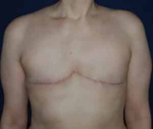 After Image: Aesthetic Flat Closure – Case 1