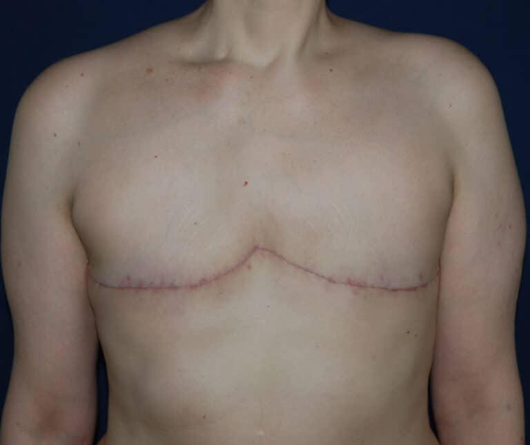 After Image: Aesthetic Flat Closure – Case 1 - front