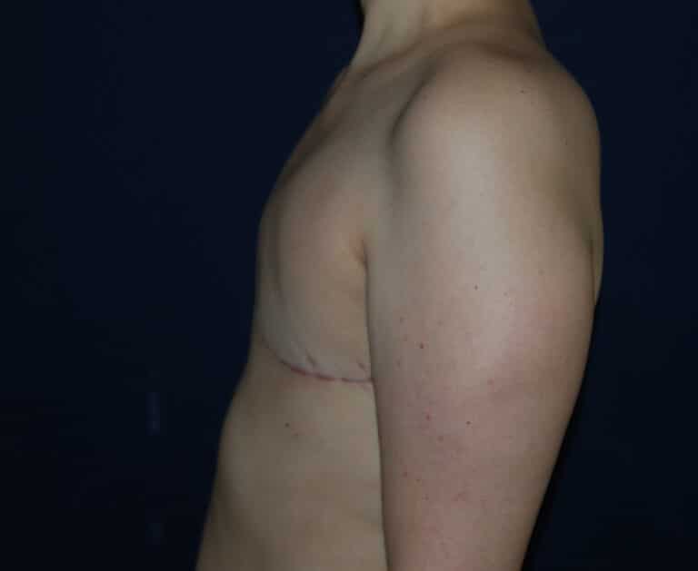 After Image: Aesthetic Flat Closure – Case 1 - left-side