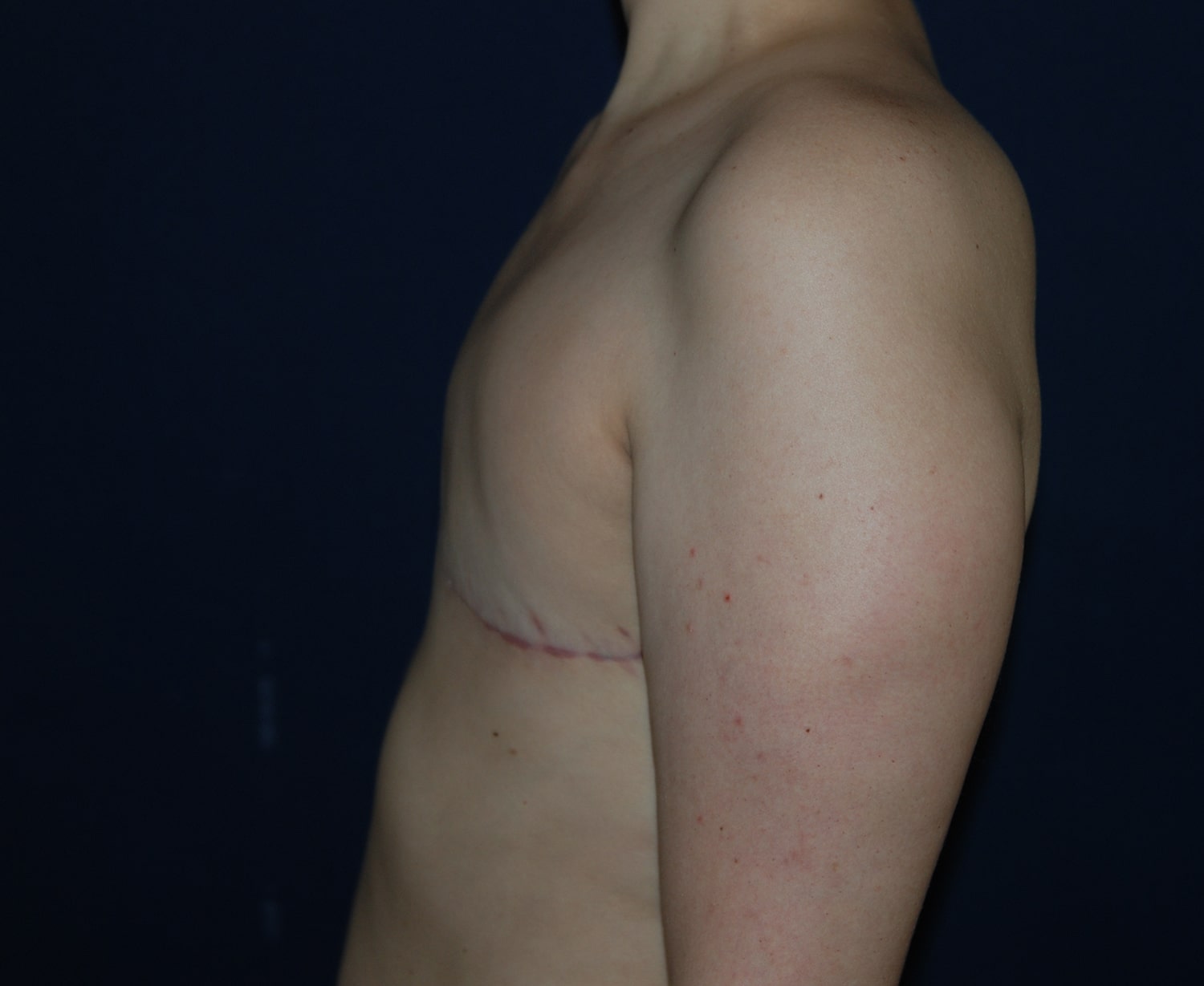 After Image: Aesthetic Flat Closure – Case 1 - left-side