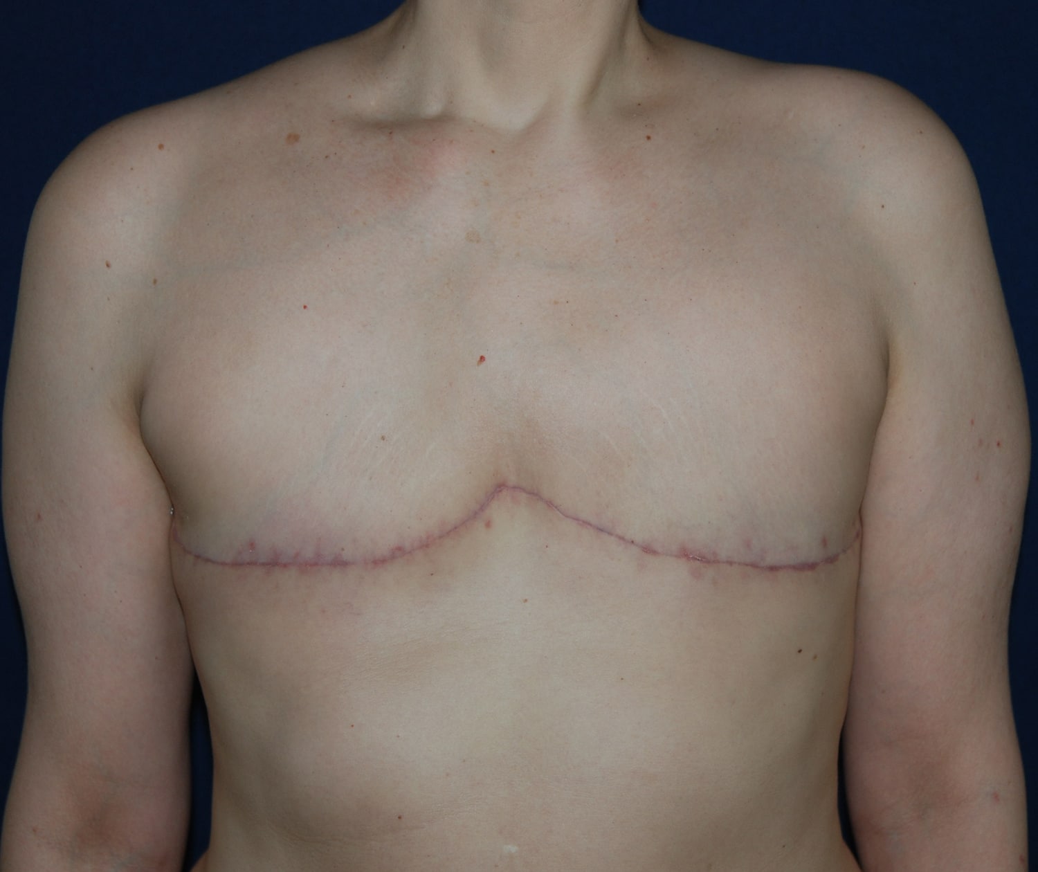 After Image: Aesthetic Flat Closure – Case 1 - front