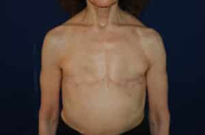 After Image: Aesthetic Flat Closure – Case 2