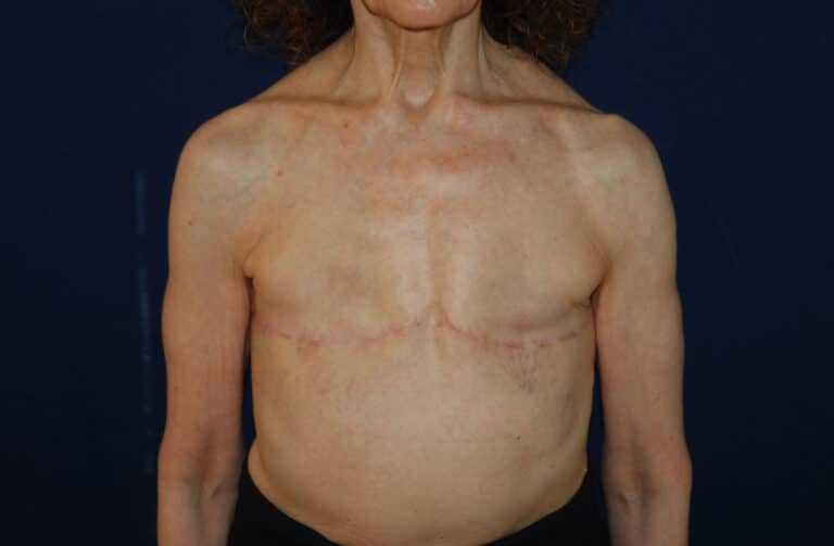 After Image: Aesthetic Flat Closure – Case 2 - front