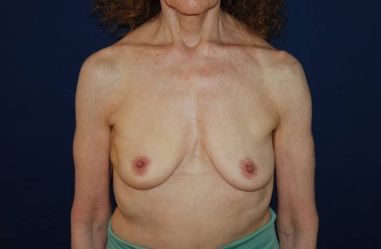 Before Image: Aesthetic Flat Closure – Case 2 - front