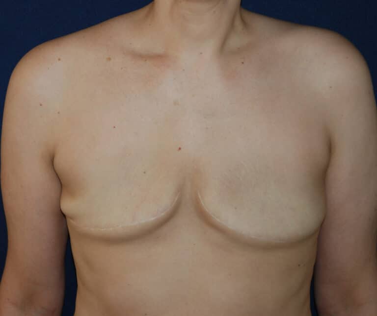 Before Image: Aesthetic Flat Closure – Case 1 - front