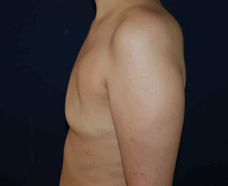 Before Image: Aesthetic Flat Closure – Case 1 - left-side