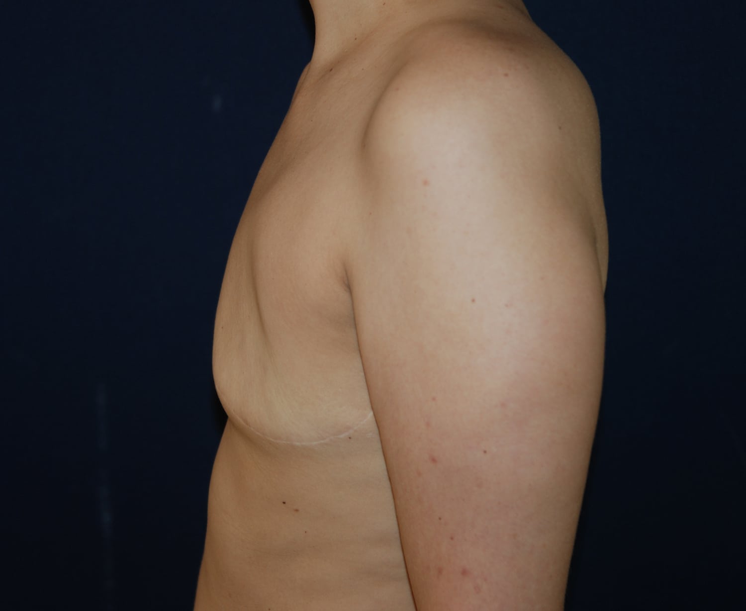 Before Image: Aesthetic Flat Closure – Case 1 - left-side