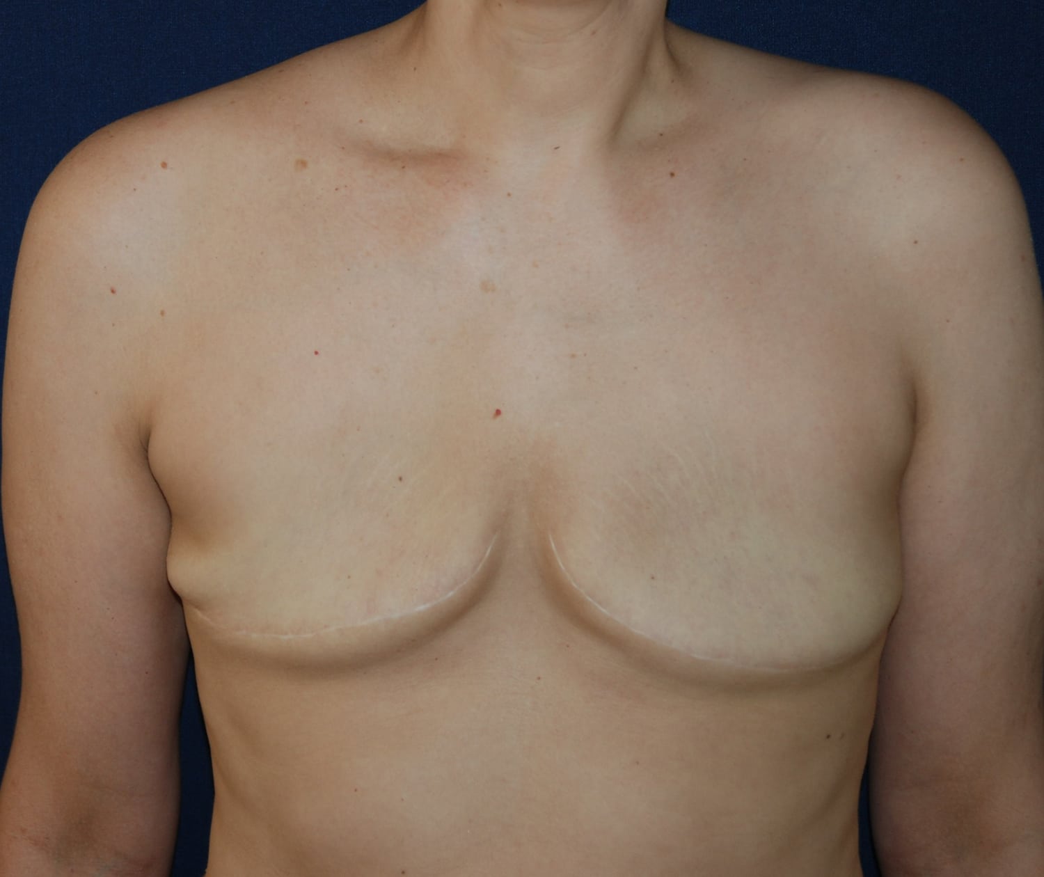 Before Image: Aesthetic Flat Closure – Case 1 - front