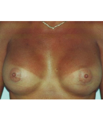 Breast Augmentation – Case 1