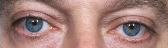 Blepharoplasty – Case 3