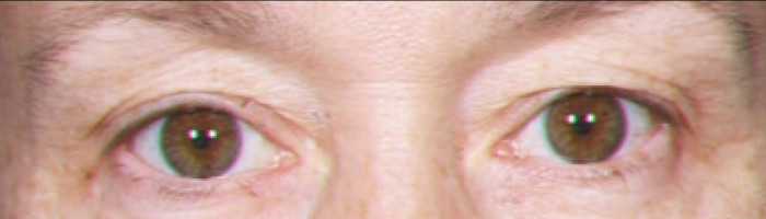 Blepharoplasty – Case 2