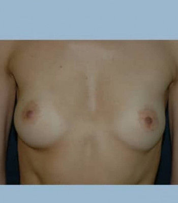 Breast Augmentation – Case 6