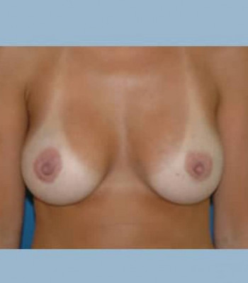 Breast Augmentation – Case 5