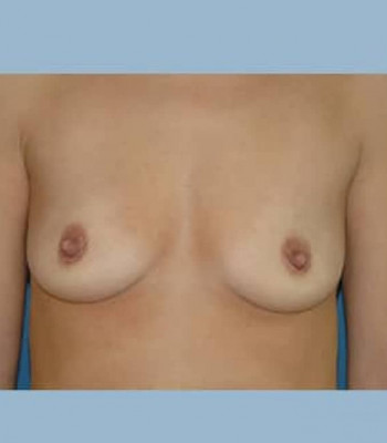 Breast Augmentation – Case 5