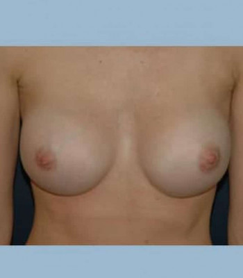 Breast Augmentation – Case 4