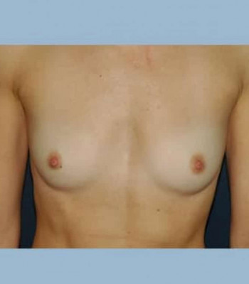 Breast Augmentation – Case 4