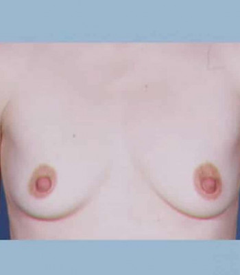 Breast Augmentation – Case 3