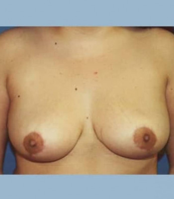 Breast Reduction – Case 4