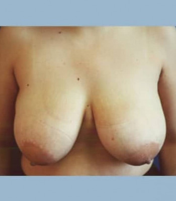 Breast Reduction – Case 4