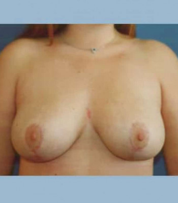 Breast Reduction – Case 3