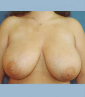 Breast Reduction – Case 3