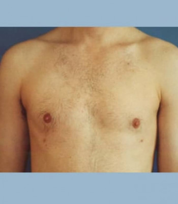 Gynecomastia – Case 2