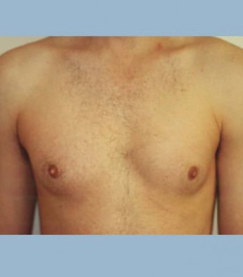 Gynecomastia – Case 2