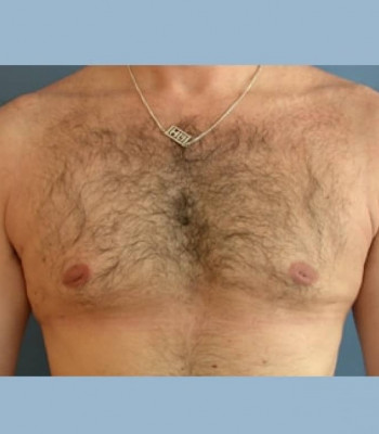 Gynecomastia – Case 1