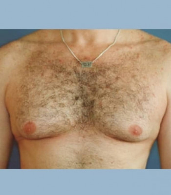 Gynecomastia – Case 1