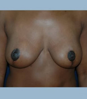 Mastopexy – Case 1