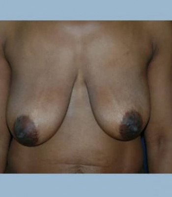 Mastopexy – Case 1