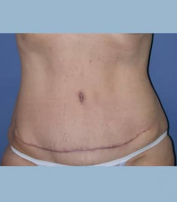 Abdominoplasty – Case 3