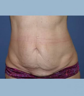 Abdominoplasty – Case 3