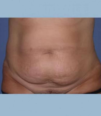 Abdominoplasty – Case 2