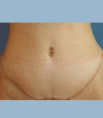 Abdominoplasty – Case 1