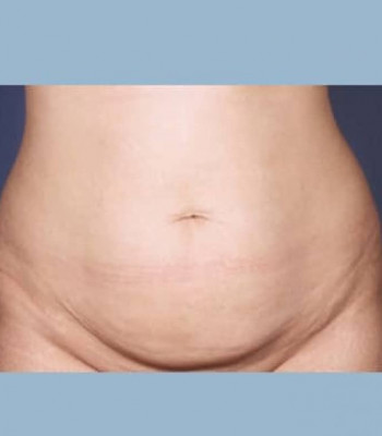 Abdominoplasty – Case 1