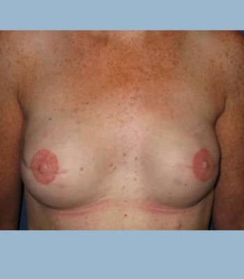 Implant Breast Reconstruction – Case 3