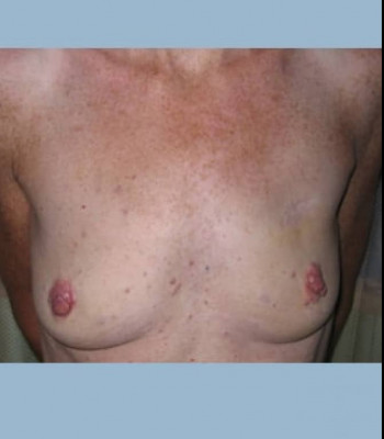 Implant Breast Reconstruction – Case 3