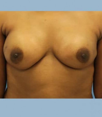 Nipple Sparing Breast Reconstruction – Case 4