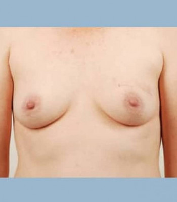 Nipple Sparing Breast Reconstruction – Case 3