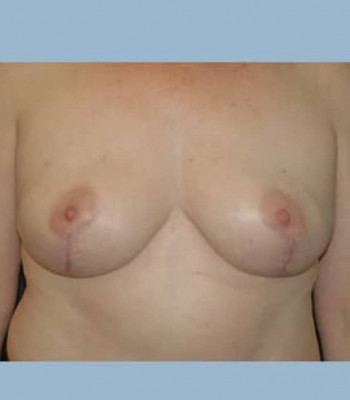 Nipple Sparing Breast Reconstruction – Case 1