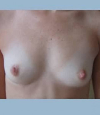 Implant Breast Reconstruction – Case 2